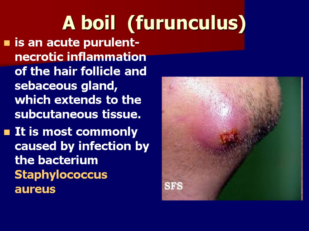 A boil (furunculus) is an acute purulent-necrotic inflammation of the hair follicle and sebaceous